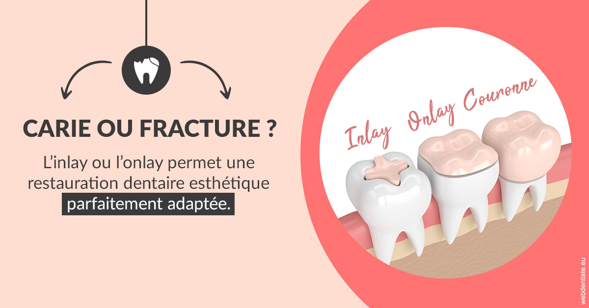 https://dr-coulange-jacques.chirurgiens-dentistes.fr/T2 2023 - Carie ou fracture 2