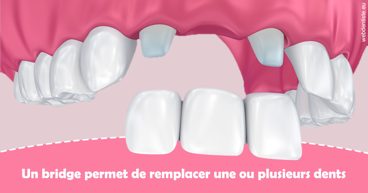 https://dr-coulange-jacques.chirurgiens-dentistes.fr/Bridge remplacer dents 2