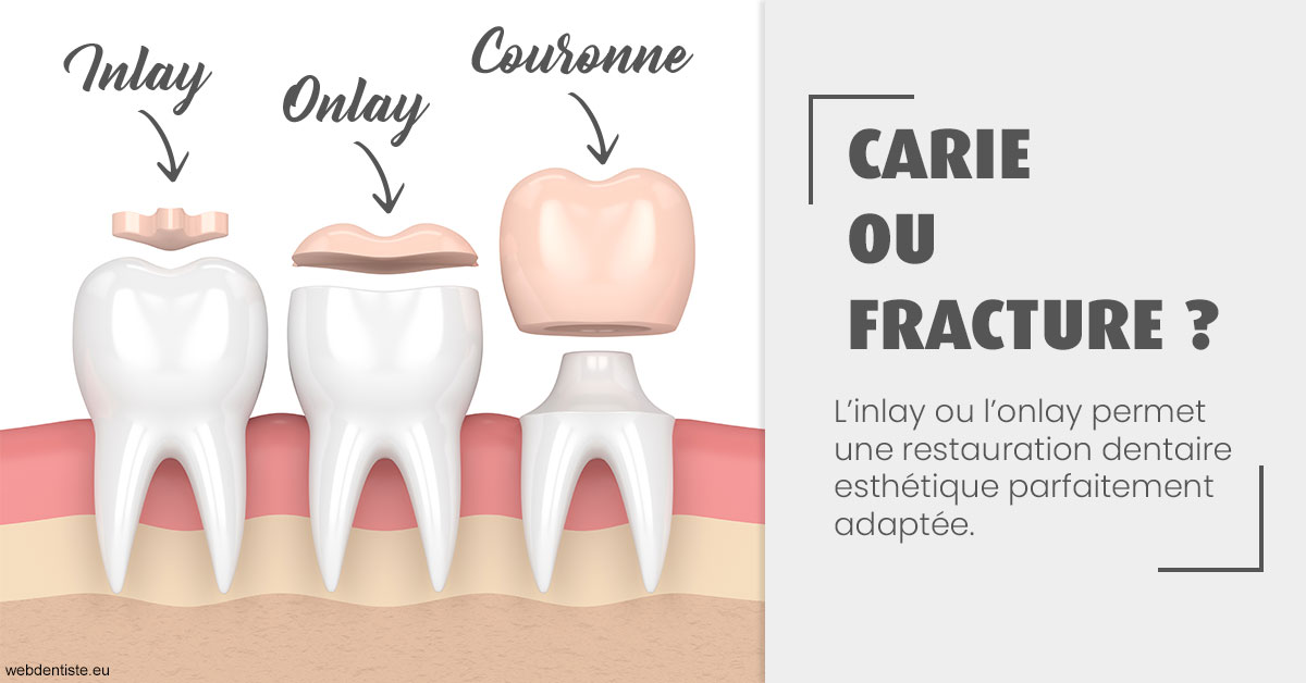 https://dr-coulange-jacques.chirurgiens-dentistes.fr/T2 2023 - Carie ou fracture 1