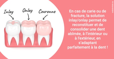https://dr-coulange-jacques.chirurgiens-dentistes.fr/L'INLAY ou l'ONLAY 2