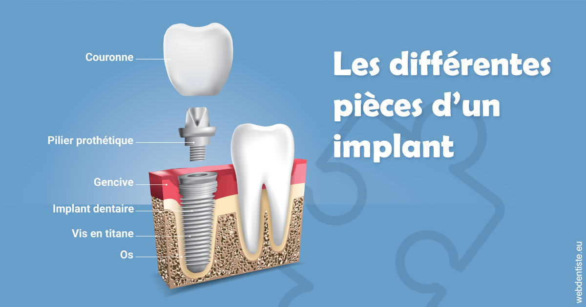 https://dr-coulange-jacques.chirurgiens-dentistes.fr/Les différentes pièces d’un implant 1